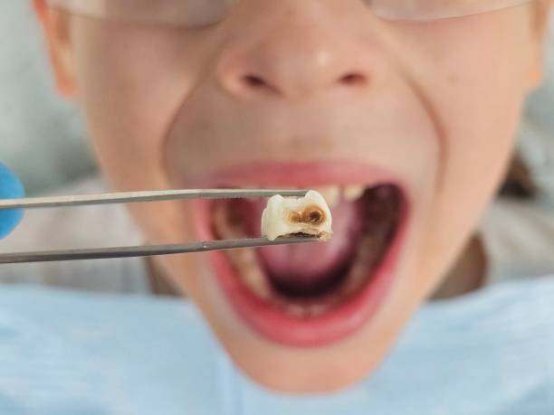 Best Broken or Cracked Tooth Emergency Dentist in Melville, NY